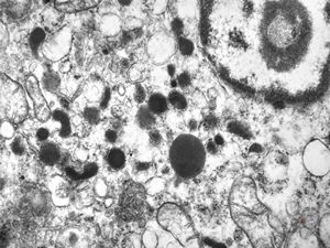 M, 38y. | pheochromocytoma M, 38y. | pheochromocytoma